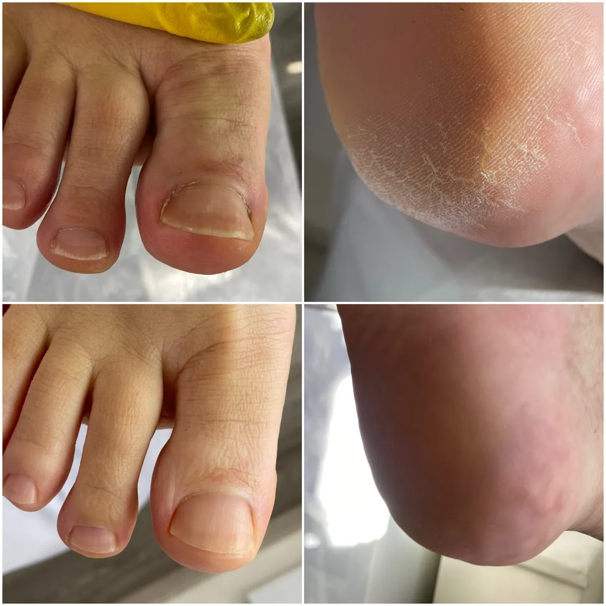 Результат роботи подолога - Апаратний педикюр