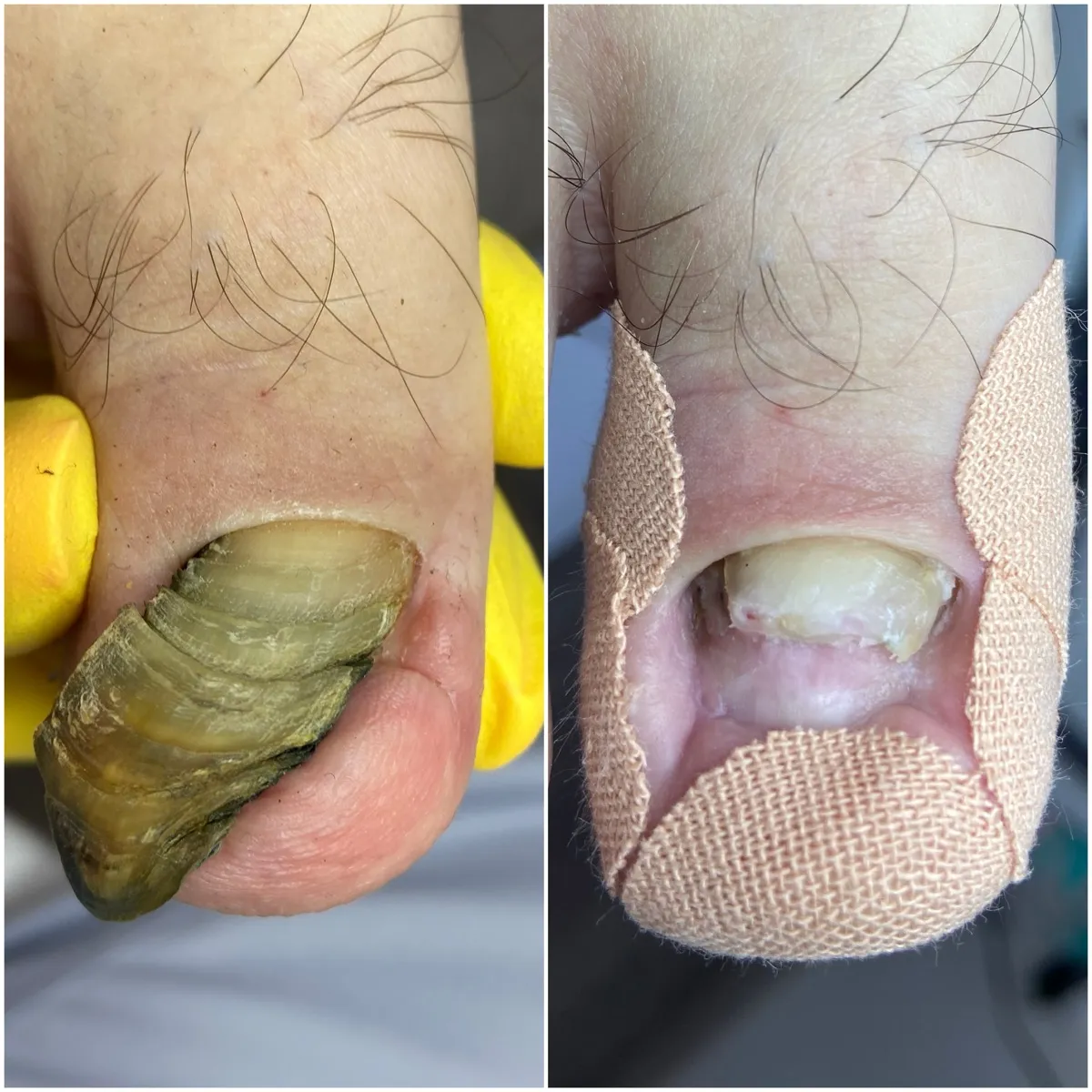 Результат роботи подолога - Врослий ніготь