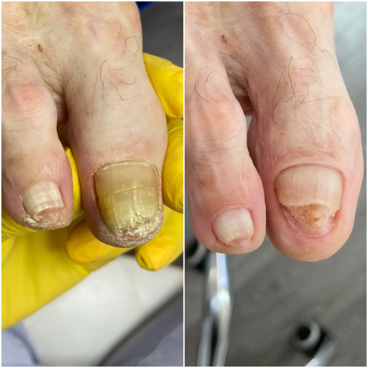 Результат роботи подолога - Тріщини та мозолі