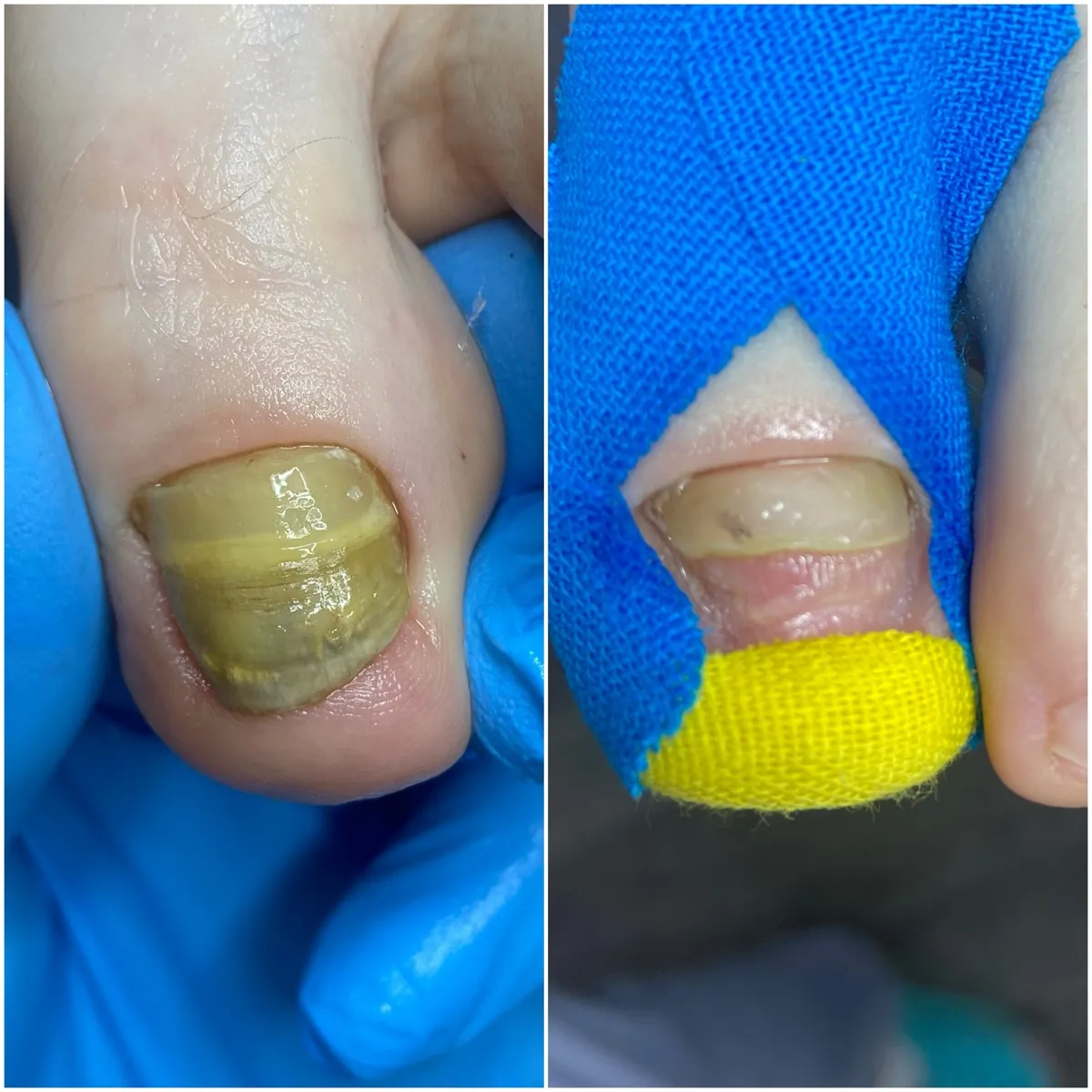 Результат роботи подолога - Обробка при грибку