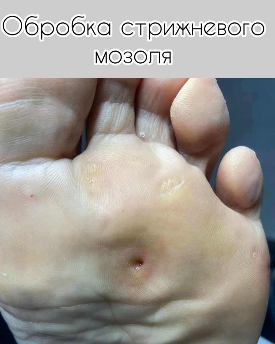 Результат роботи подолога - Апаратний педикюр