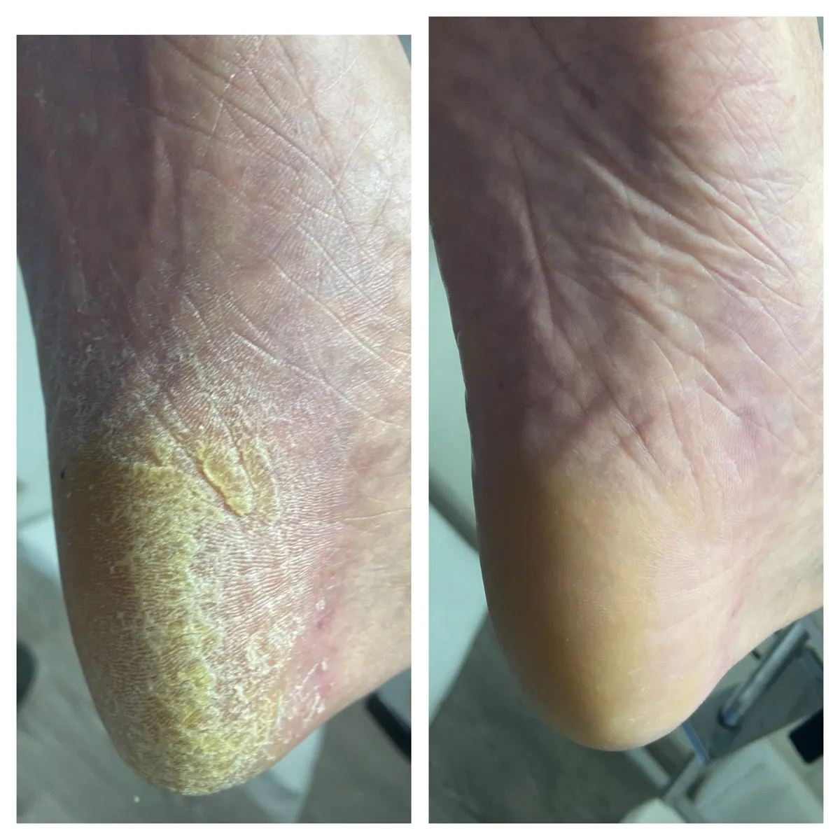 Результат роботи подолога - Врослий ніготь