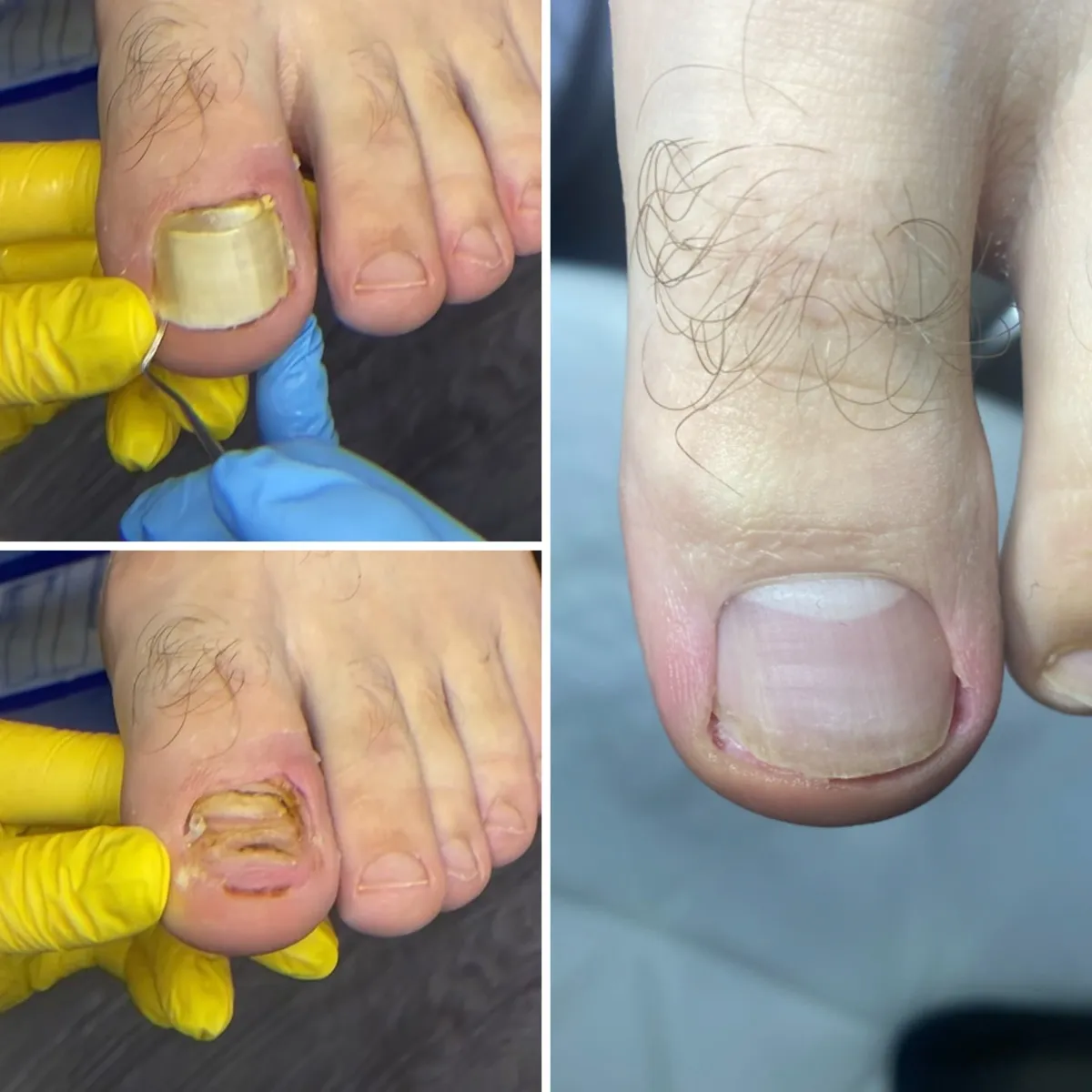 Результат роботи подолога - Тріщини та мозолі