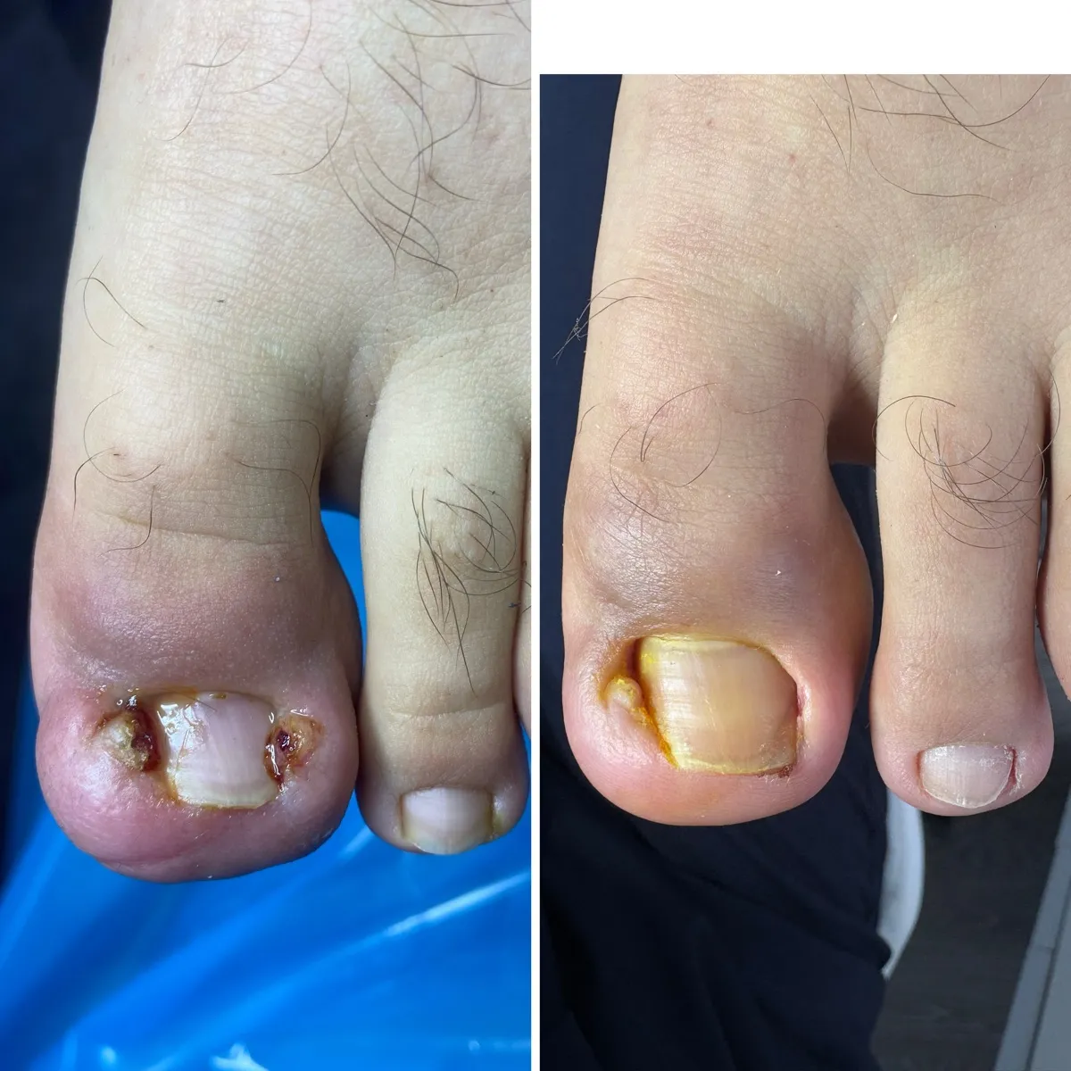 Результат роботи подолога - Обробка при грибку