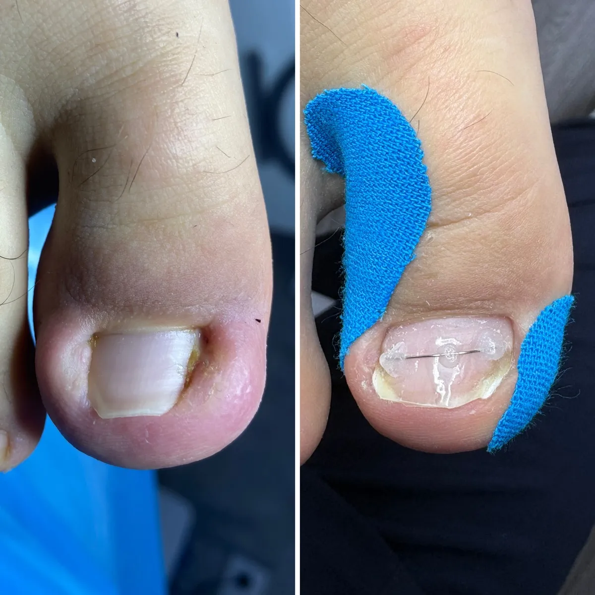 Результат роботи подолога - Деформації та травми