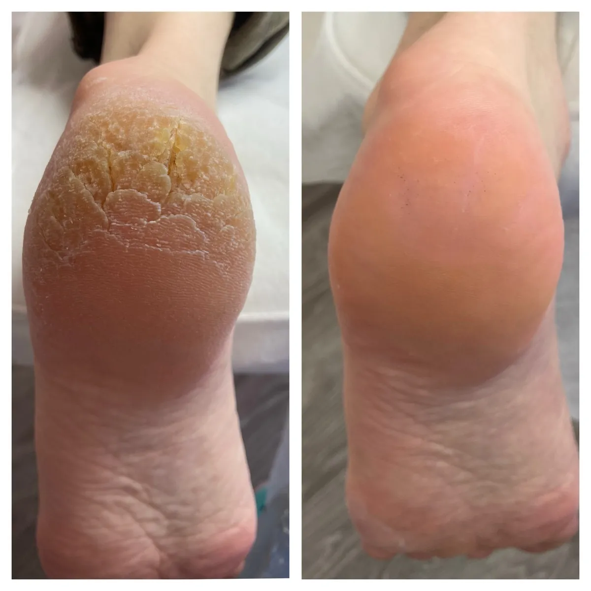 Результат роботи подолога - Апаратний педикюр