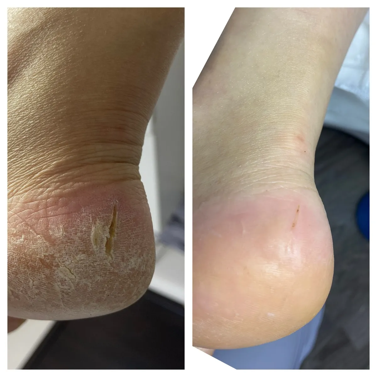 Результат роботи подолога - Врослий ніготь