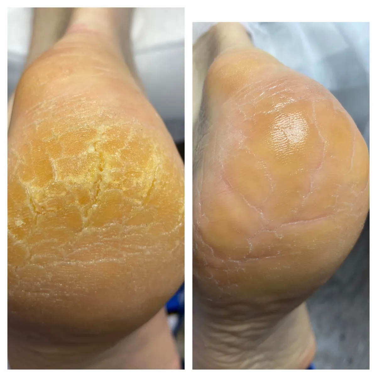 Результат роботи подолога - Тріщини та мозолі