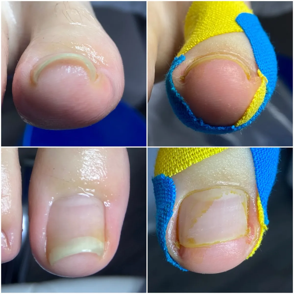 Результат роботи подолога - Обробка при грибку