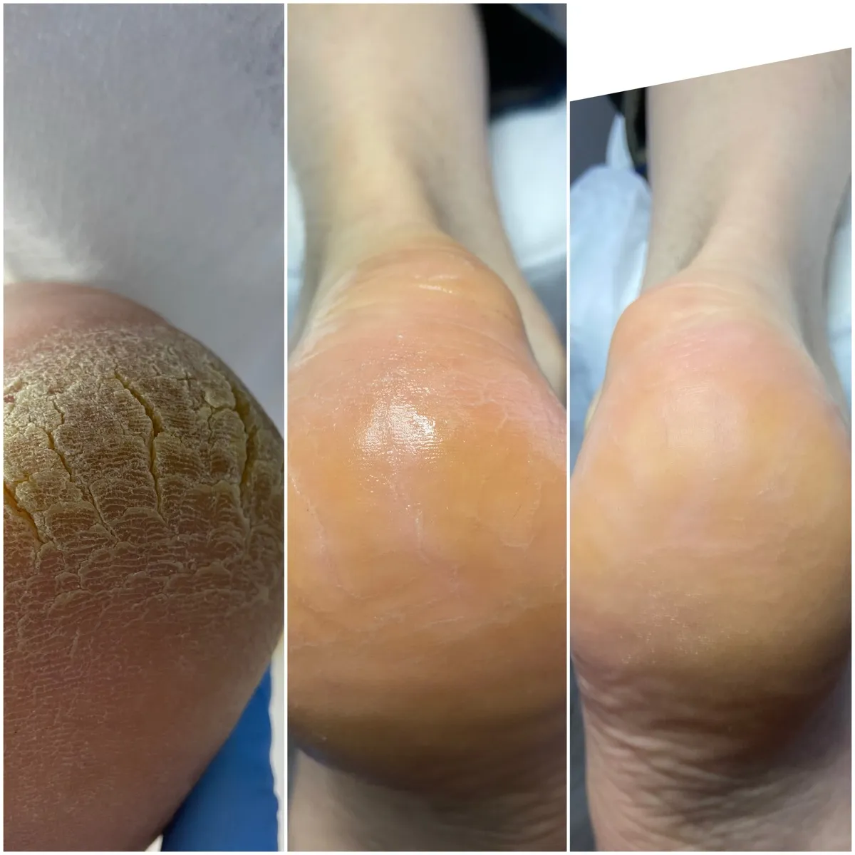 Результат роботи подолога - Деформації та травми