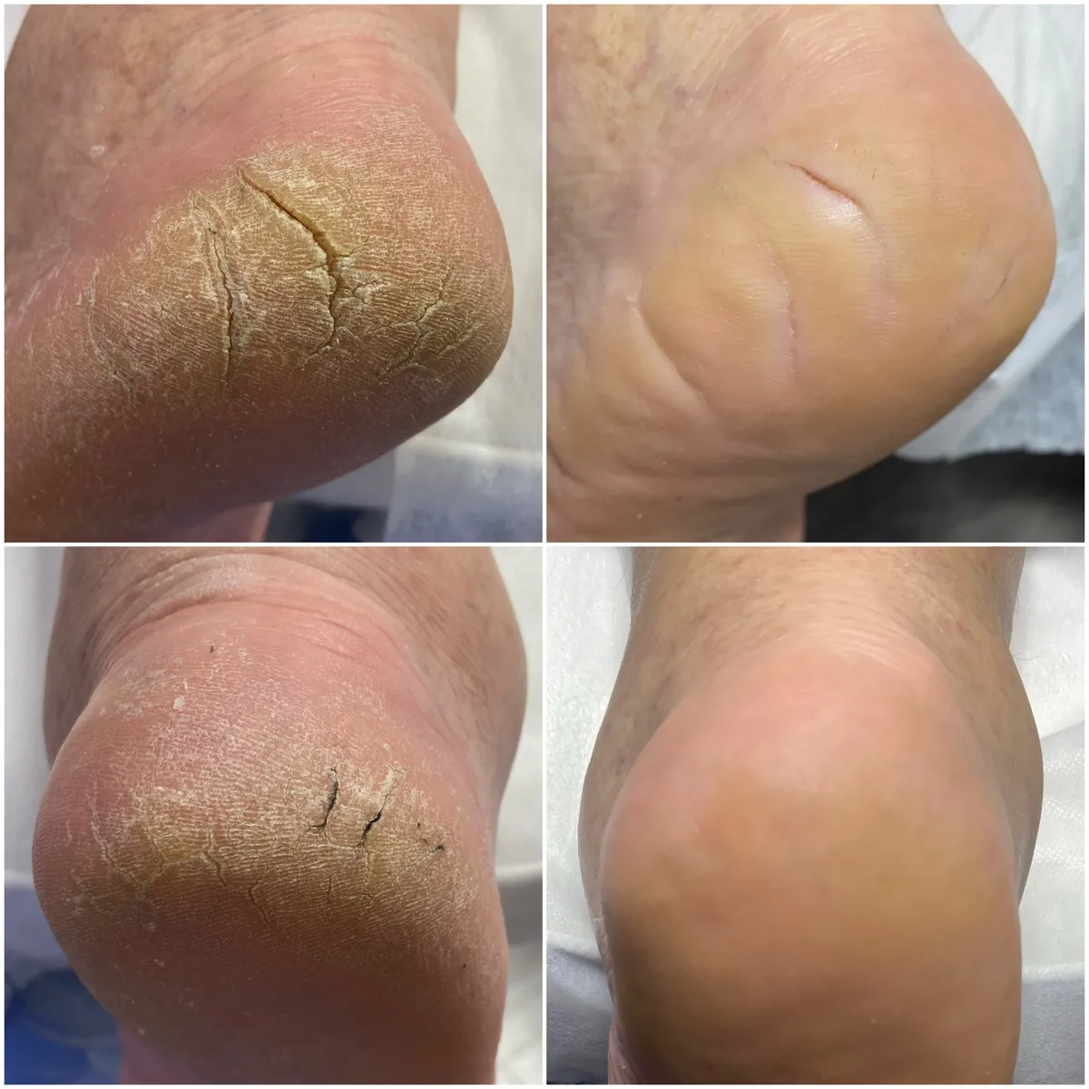 Результат роботи подолога - Апаратний педикюр