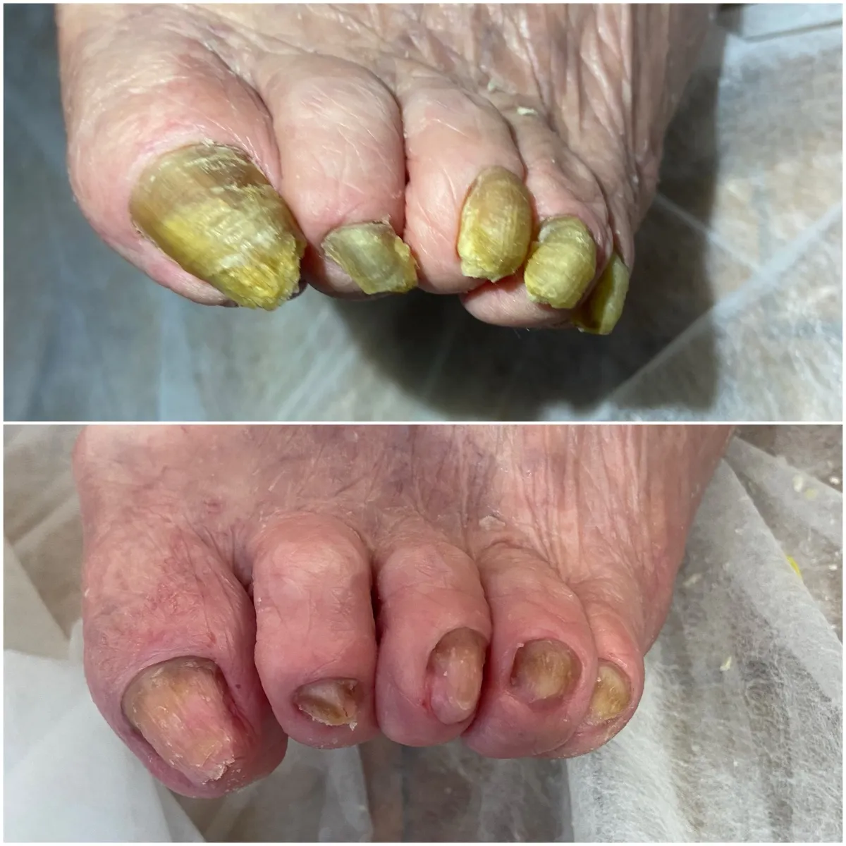 Результат роботи подолога - Врослий ніготь