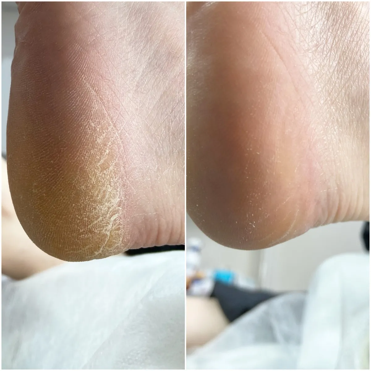 Результат роботи подолога - Тріщини та мозолі