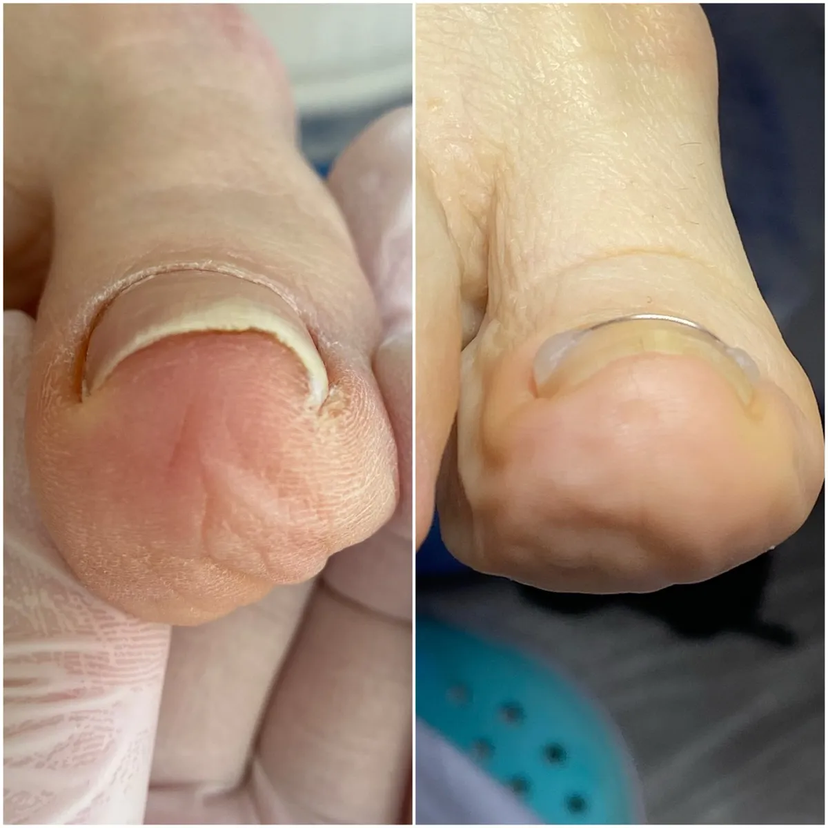 Результат роботи подолога - Обробка при грибку