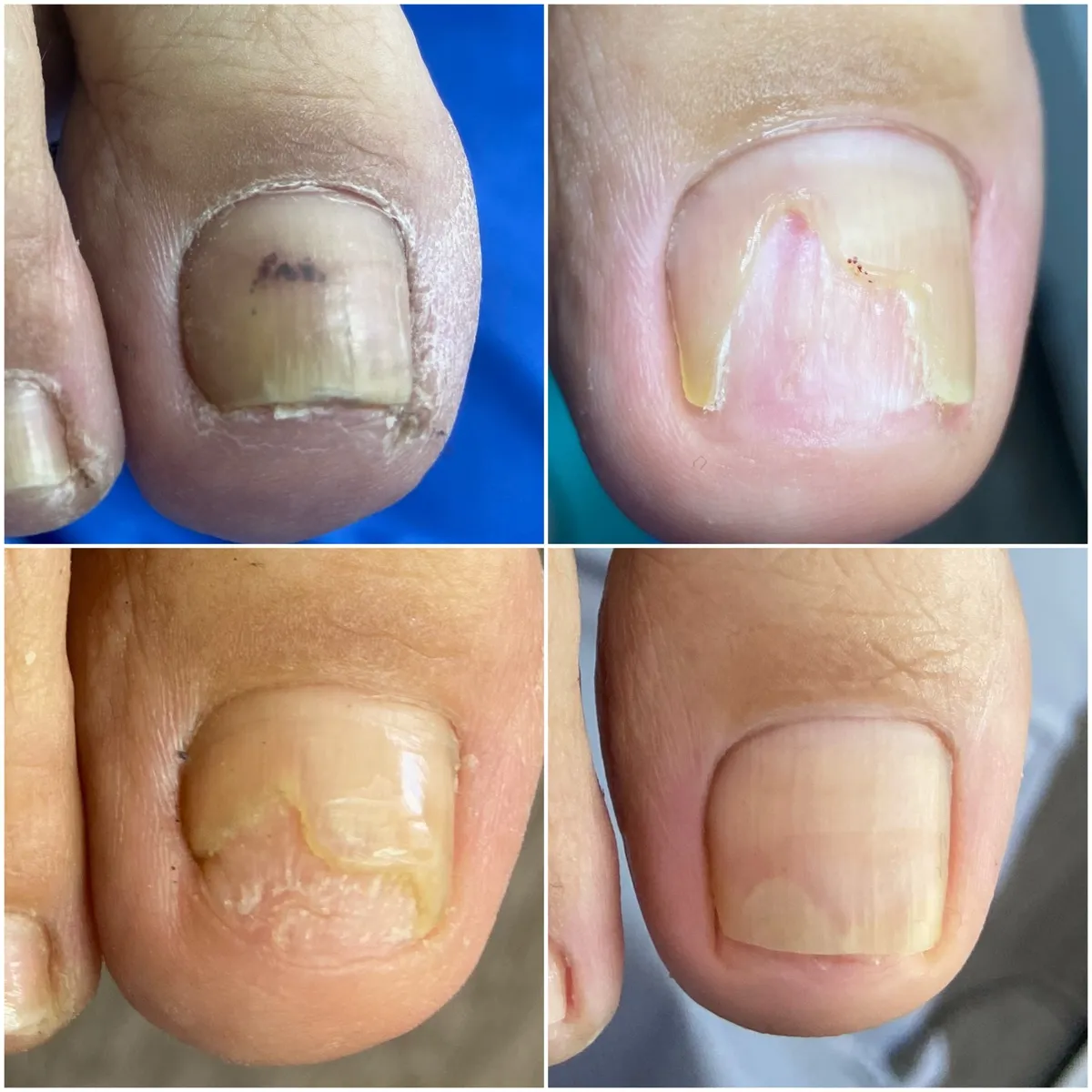 Результат роботи подолога - Деформації та травми