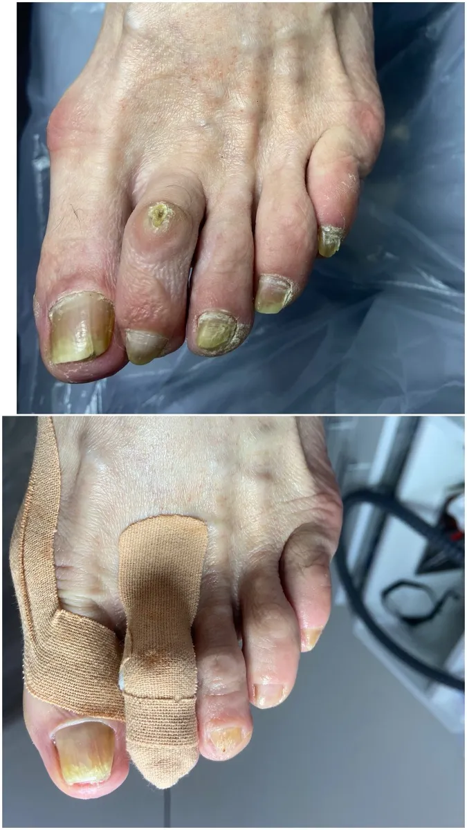 Результат роботи подолога - Апаратний педикюр