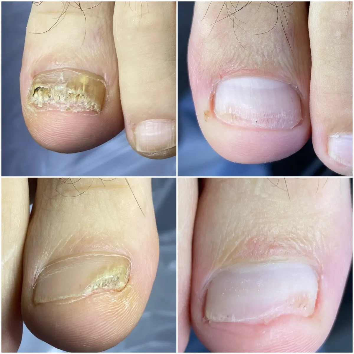 Результат роботи подолога - Врослий ніготь