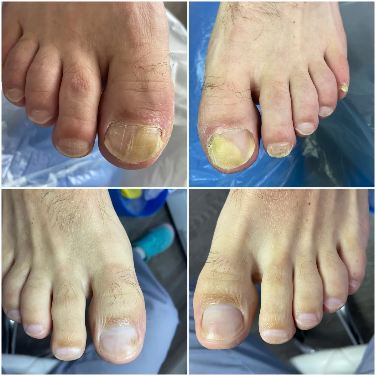 Результат роботи подолога - Тріщини та мозолі