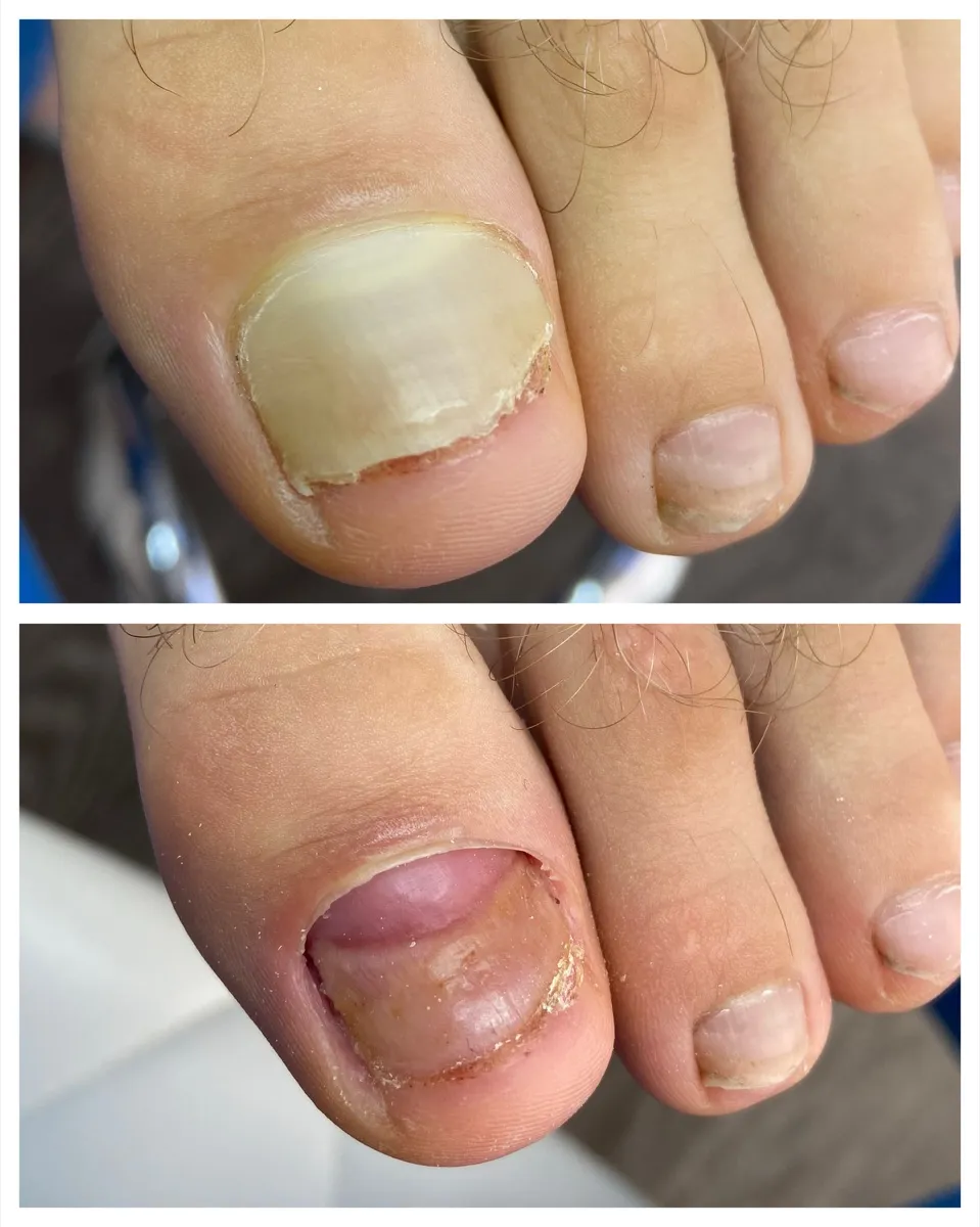 Результат роботи подолога - Обробка при грибку