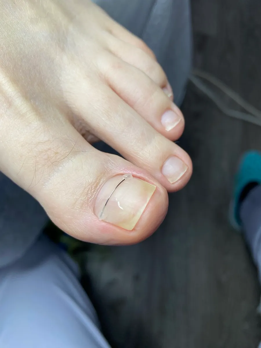 Результат роботи подолога - Врослий ніготь